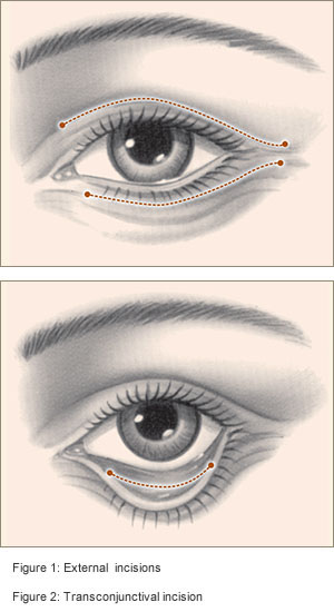 Eyelid-Surgery