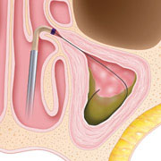 Sinus-Balloon-Step1