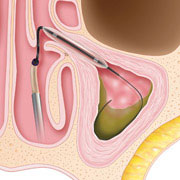 Sinus-Balloon-Step2