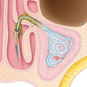 Sinus-Balloon-Step3